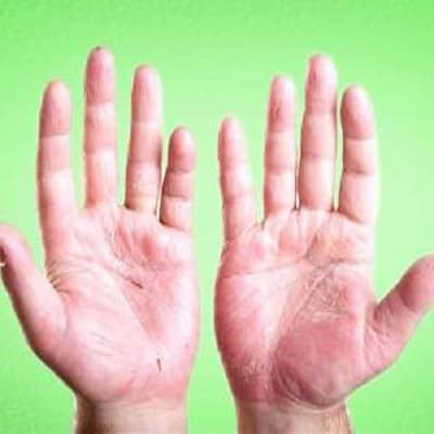 پوسته شدن کف دست ناشی از کمبود ویتامین های گروه B